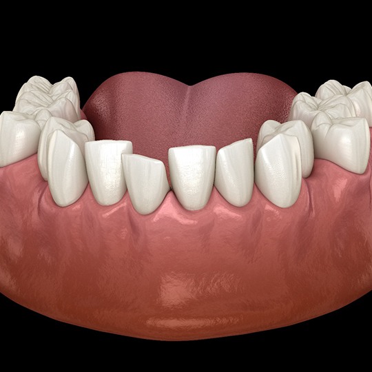 Digital illustration of crowded teeth in Atlanta before Spark Aligners 