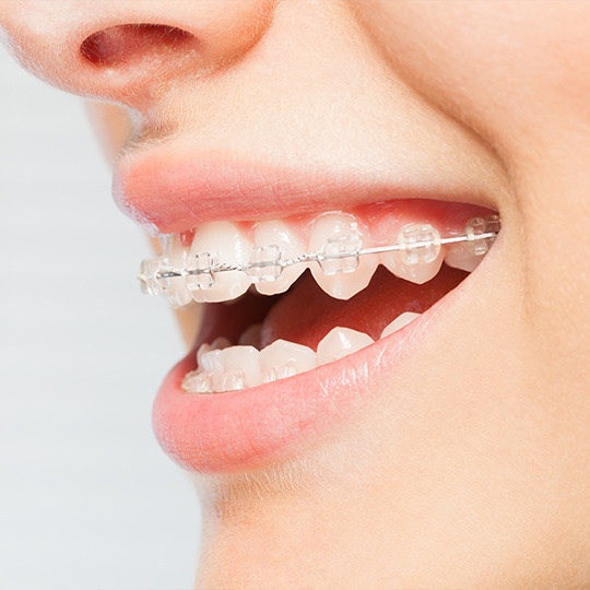 Smile with clear and ceramic braces