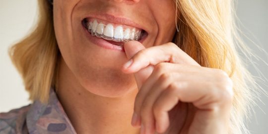 woman putting on Spark Clear Aligner  