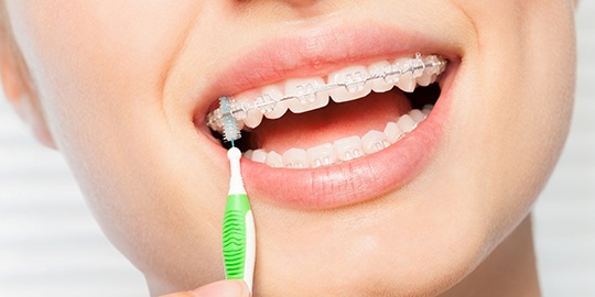 Nose-to-chin view of woman cleaning braces with interproximal brush