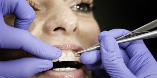 Orthodontist repairing a loose or broken braces bracket and bands