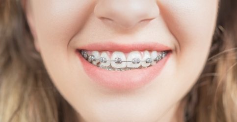Smile with metal braces