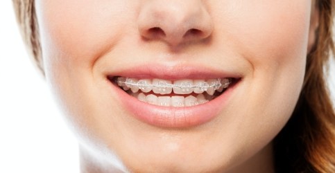Smile with cearmic braces