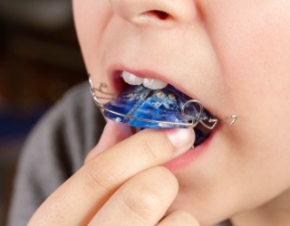 Closeup of patient placing an orthodontic retainer