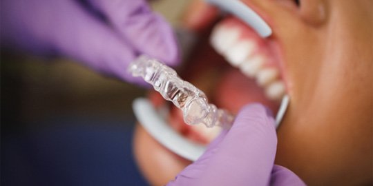 Patient receiving Invisalign in Atlanta