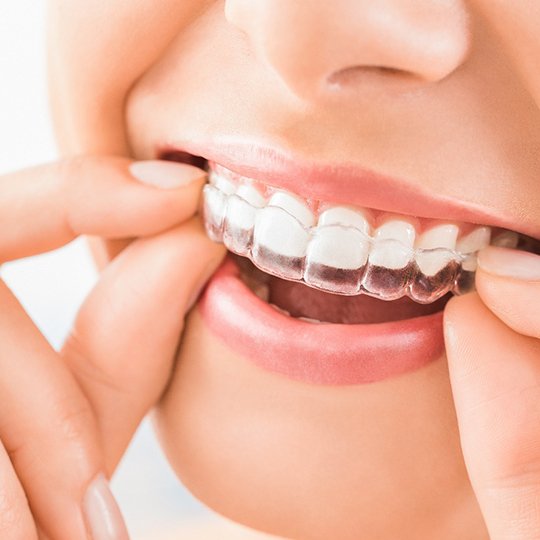 Closeup of patient wearing Spark Clear Aligners in Atlanta