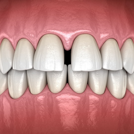 Digital illustration of gap between front teeth in Atlanta before Spark Aligners