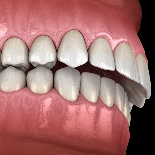 Digital illustration of overbite in Atlanta before Spark Aligners