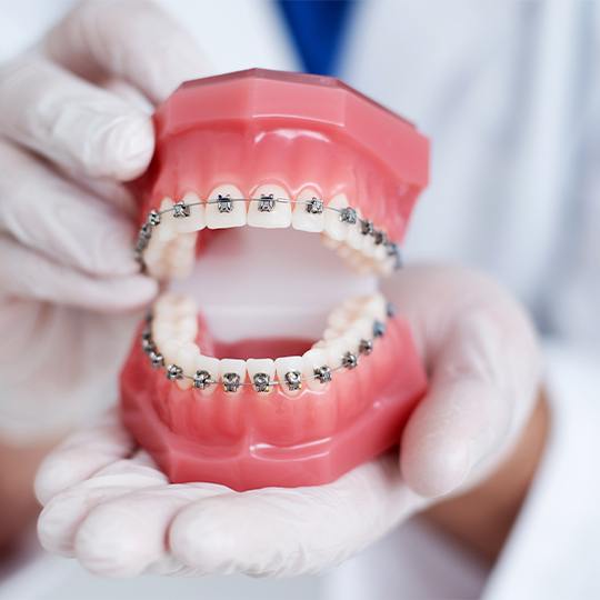 Model smile with traditional braces