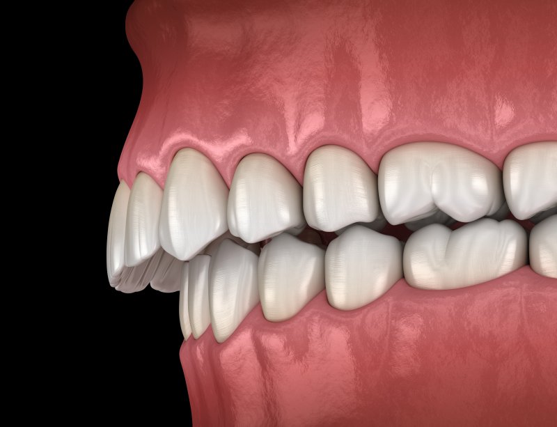 Digital illustration of overbite