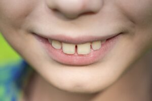 Close-up of person showing overbite.